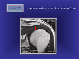 Case 2   ( Supraspinatus partial tear (Bursal side
 