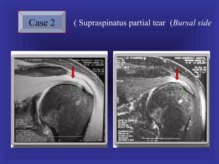 Case 2   ( Supraspinatus partial tear (Bursal side
 