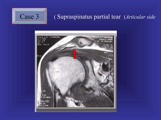 Case 3   ( Supraspinatus partial tear (Articular side
 