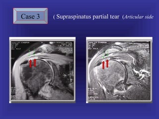 Case 3   ( Supraspinatus partial tear (Articular side
 