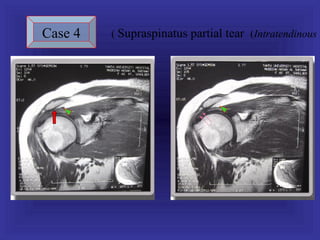 Case 4   ( Supraspinatus partial tear (Intratendinous
 