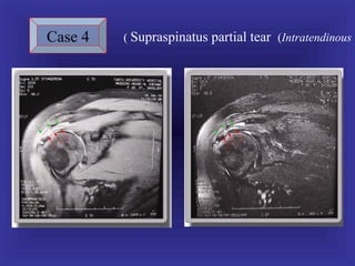 Case 4   ( Supraspinatus partial tear (Intratendinous
 