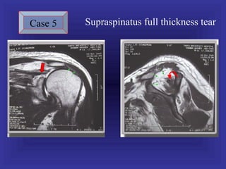 Case 5   Supraspinatus full thickness tear
 
