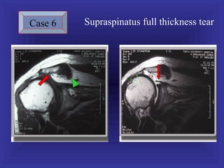 Case 6   Supraspinatus full thickness tear
 