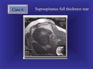 Case 6   Supraspinatus full thickness tear
 