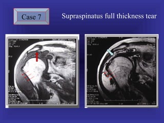 Case 7   Supraspinatus full thickness tear
 
