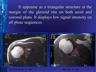 It appearse as a triangular structure at the
margin of the glenoid rim on both axial and
coronal plans. It displays low signal intensity on
all pluse sequences.




C O R O N AL T1 WI              AX IAL T1 WI
 