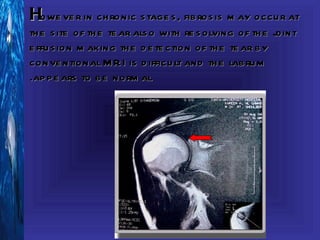 Howe ve r in ch ronic s tage s , fib ros is m ay occu r at
th e s ite of th e te ar als o with re s olving of th e joint
e ffu s ion m aking th e d e te ction of th e te ar b y
conve ntional M R I is d ifficu lt and th e lab ru m
.ap p e ars to b e norm al
 