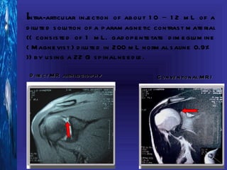 Intra-articu lar inje ction of ab ou t 1 0 – 1 2 m L of a
d ilu te d s olu tion of a p aram agne tic contras t m ate rial
(( cons is te d of 1 m L. gad op e nte tate d im e glu m ine
( M agne vis t ) d ilu te d in 200 m L norm al s aline 0.9%
)) b y u s ing a 22 G s p inal ne e d le .

 D ire ct M R arth rograp h y              C onve ntional M R I
 