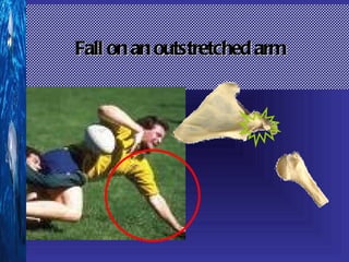 Fall on an outstretched arm
 