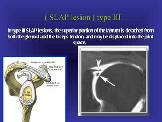 ( SLAP lesion ( type III
In type III SLAP lesions, the superior portion of the labrum is detached from
both the glenoid and the biceps tendon, and may be displaced into the joint
                                    space.
 