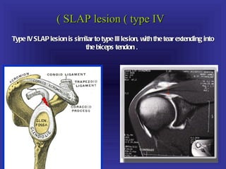 ( SLAP lesion ( type IV
Type IV SLAP lesion is similar to type III lesion, with the tear extending into
                           the biceps tendon .
 