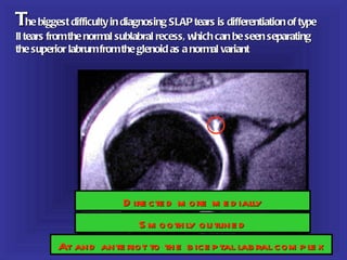 The biggest difficulty in diagnosing SLAP tears is differentiation of type
II tears from the normal sublabral recess, which can be seen separating
the superior labrum from the glenoid as a normal variant




                          D ire cte d m ore m e d ially
                              S m ooth ly ou tline d
          At and ante riot to th e b ice p tal lab ral com p le x
 