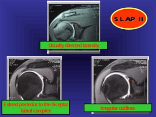 S LAP II


                      Usually directed laterally




Extend posterior to the biceptal
        labral complex                             Irregular outlines
 