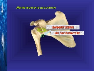 Ante rior d is location



                    BANKART LESION
                      HILL SACHS FRACTURE
 