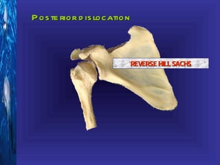 P os te rior d is location



                             REVERSE HILL SACHS
 