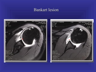 Bankart lesion
 