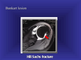 Bankart lesion




                 Hill Sachs fracture
 
