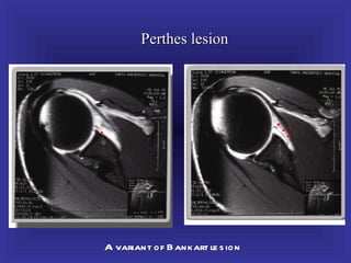 Perthes lesion




A variant of Bankart le s ion
 