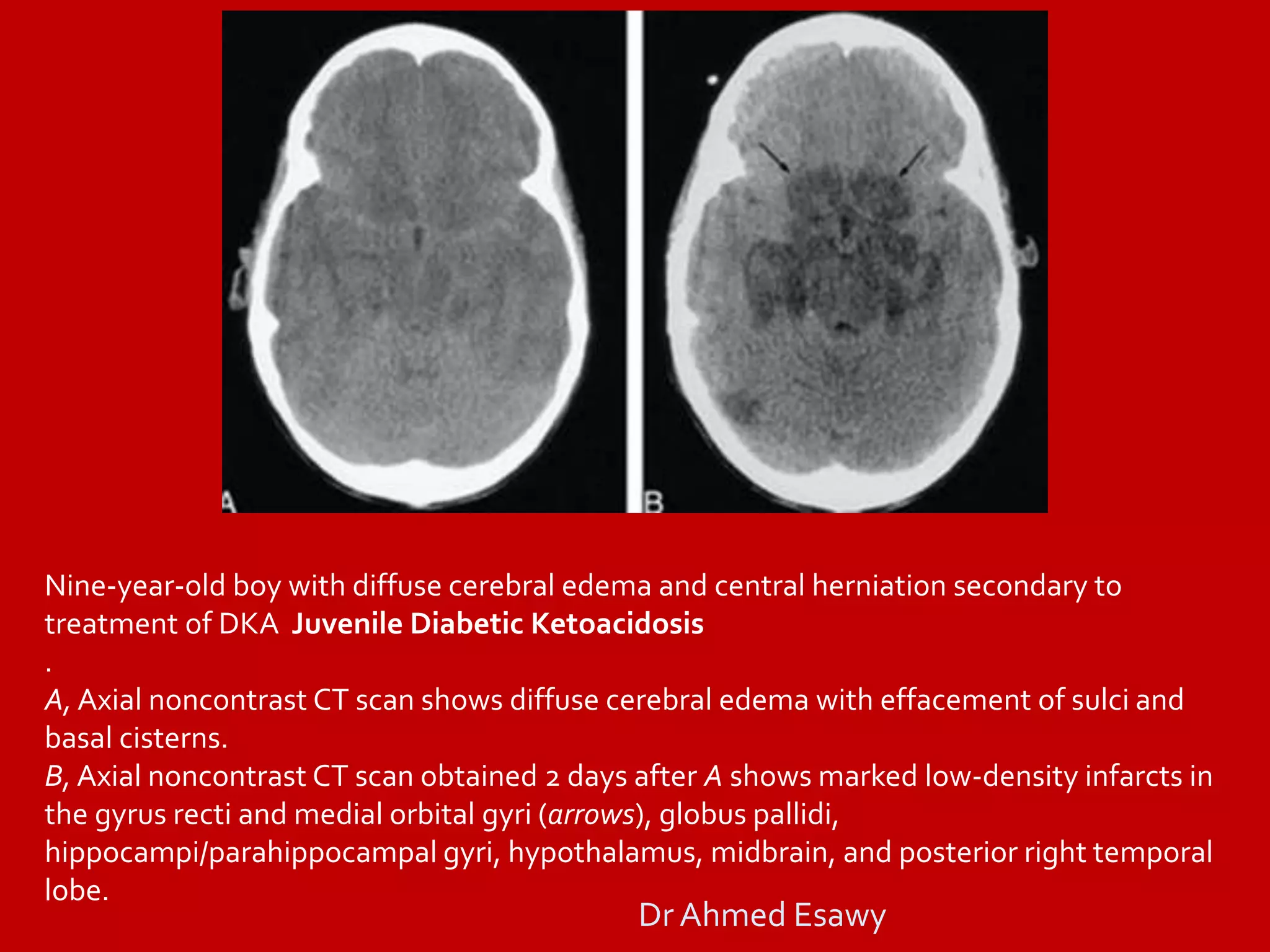 Full story brain herniation imaging Dr Ahmed Esawy | PDF