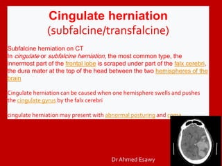 Subfalcine Full story brain herniation imaging Dr Ahmed Esawy | PDF