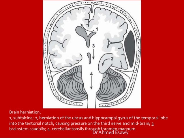 brain herniation
