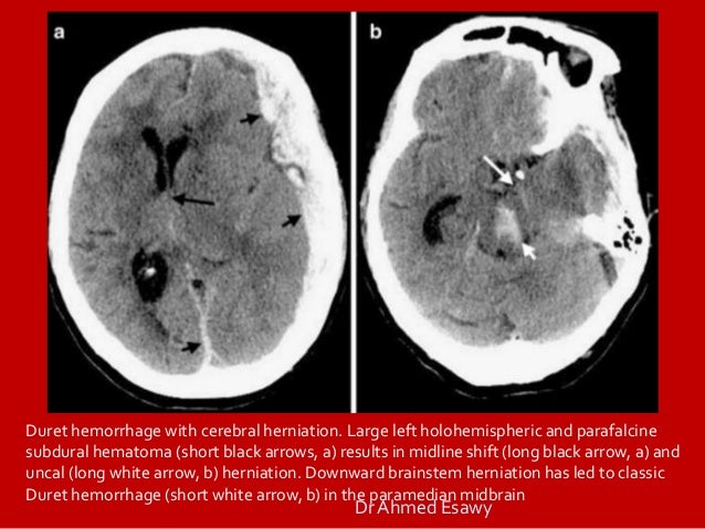 brain herniation