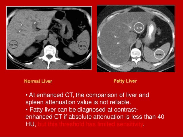Full Story Fatty Liver Imaging Dr Ahmed Esawy