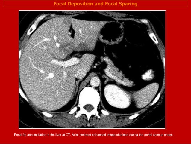 Full story fatty liver imaging Dr Ahmed Esawy