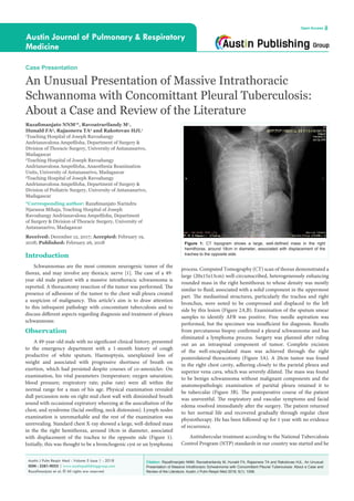 Citation: Razafimanjato NNM, Ravoatrarilandy M, Hunald FA, Rajaonera TA and Rakotovao HJL. An Unusual
Presentation of Massive Intrathoracic Schwannoma with Concomittant Pleural Tuberculosis: About a Case and
Review of the Literature. Austin J Pulm Respir Med 2018; 5(1): 1058.
Austin J Pulm Respir Med - Volume 5 Issue 1 - 2018
ISSN : 2381-9022 | www.austinpublishinggroup.com
Razafimanjato et al. © All rights are reserved
Austin Journal of Pulmonary & Respiratory
Medicine
Open Access
Introduction
Schwannomas are the most common neurogenic tumor of the
thorax, and may involve any thoracic nerve [1]. The case of a 49-
year old male patient with a massive intrathoracic schwannoma is
reported. A thoracotomy resection of the tumor was performed. The
presence of adhesions of the tumor to the chest wall pleura created
a suspicion of malignancy. This article’s aim is to draw attention
to this infrequent pathology with concomitant tuberculosis and to
discuss different aspects regarding diagnosis and treatment of pleura
schwannome.
Observation
A 49-year-old male with no significant clinical history, presented
to the emergency department with a 1-month history of cough
productive of white sputum, Haemoptysis, unexplained loss of
weight and associated with progressive shortness of breath on
exertion, which had persisted despite courses of co-amoxiclav. On
examination, his vital parameters (temperature; oxygen saturation;
blood pressure; respiratory rate; pulse rate) were all within the
normal range for a man of his age. Physical examination revealed
dull percussion note on right mid chest wall with diminished breath
sound with occasional expiratory wheezing at the auscultation of the
chest, and syndrome (facial swelling, neck distension). Lymph nodes
examination is unremarkable and the rest of the examination was
unrevealing. Standard chest X-ray showed a large, well-defined mass
in the the right hemithorax, around 18cm in diameter, associated
with displacement of the trachea to the opposite side (Figure 1).
Initially, this was thought to be a bronchogenic cyst or un lymphoma
Case Presentation
An Unusual Presentation of Massive Intrathoracic
Schwannoma with Concomittant Pleural Tuberculosis:
About a Case and Review of the Literature
Razafimanjato NNM1
*, Ravoatrarilandy M1
,
Hunald FA3
, Rajaonera TA2
and Rakotovao HJL1
1
Teaching Hospital of Joseph Ravoahangy
Andrianavalona Ampefiloha, Department of Surgery &
Division of Thoracic Surgery, University of Antananarivo,
Madagascar
2
Teaching Hospital of Joseph Ravoahangy
Andrianavalona Ampefiloha, Anaesthesia Reanimation
Units, University of Antananarivo, Madagascar
3
Teaching Hospital of Joseph Ravoahangy
Andrianavalona Ampefiloha, Department of Surgery &
Division of Pediatric Surgery, University of Antananarivo,
Madagascar
*Corresponding author: Razafimanjato Narindra
Njarasoa Mihaja, Teaching Hospital of Joseph
Ravoahangy Andrianavalona Ampefiloha, Department
of Surgery & Division of Thoracic Surgery, University of
Antananarivo, Madagascar
Received: December 12, 2017; Accepted: February 19,
2018; Published: February 26, 2018
process. Computed Tomography (CT) scan of thorax demonstrated a
large (20x15x13cm) well-circumscribed, heterogeneously enhancing
rounded mass in the right hemithorax to whose density was mostly
similar to fluid, associated with a solid component in the uppermost
part. The mediastinal structures, particularly the trachea and right
bronchus, were noted to be compressed and displaced to the left
side by this lesion (Figure 2A,B). Examination of the sputum smear
samples to identify AFB was positive. Fine needle aspiration was
performed, but the specimen was insufficient for diagnosis. Results
from percutanous biopsy confirmed a pleural schwannome and has
eliminated a lymphoma process. Surgery was planned after ruling
out an an intraspinal component of tumor. Complete excision
of the well-encapsulated mass was achieved through the right
posterolateral thoracotomy (Figure 3A). A 20cm tumor was found
in the right chest cavity, adhering closely to the parietal pleura and
superior vena cava, which was severely dilated. The mass was found
to be benign schwannoma without malignant components and the
anatomopathologic examination of pariétal pleura retained it to
be tubercular (Figure 3B). The postoperative course of the patient
was uneventful. The respiratory and vascular symptoms and facial
edema resolved immediately after the surgery. The patient returned
to her normal life and recovered gradually through regular chest
physiotherapy. He has been followed-up for 1 year with no evidence
of recurrence.
Antitubercular treatment according to the National Tuberculosis
Control Program (NTP) standards in our country was started and he
Figure 1: CT topogram shows a large, well-defined mass in the right
hemithorax, around 18cm in diameter, associated with displacement of the
trachea to the opposite side.
 