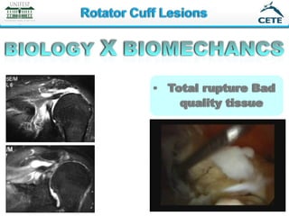 Full thickness rotator cuff: Diagnosis and Management | PDF