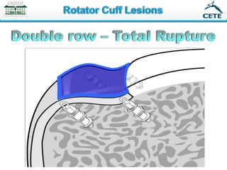 Full thickness rotator cuff: Diagnosis and Management | PDF