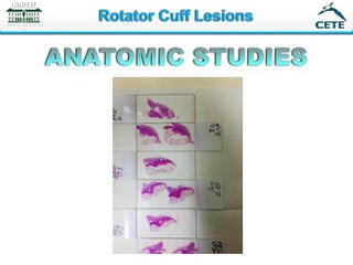Full thickness rotator cuff: Diagnosis and Management | PDF