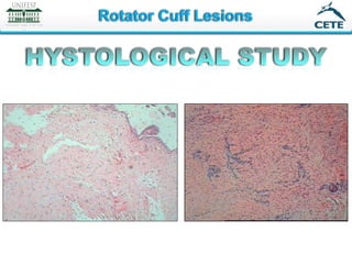 Full thickness rotator cuff: Diagnosis and Management | PDF