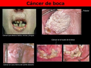 Cáncer de boca Cáncer que afecta a labios, encías y lengua.  Paladar Cáncer en el suelo de la boca Cáncer en cara interna del carrillo derecho 