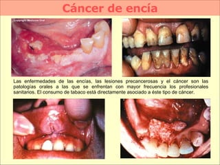 Cáncer de encía Las enfermedades de las encías, las lesiones precancerosas y el cáncer son las patologías orales a las que se enfrentan con mayor frecuencia los profesionales sanitarios. El consumo de tabaco está directamente asociado a éste tipo de cáncer.  