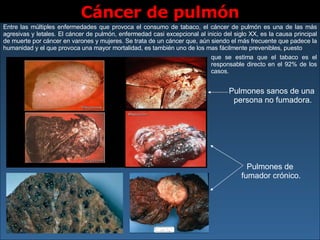 Cáncer de pulmón Pulmones de  fumador crónico. Pulmones sanos de una  persona no fumadora. Entre las múltiples enfermedades que provoca el consumo de tabaco, el cáncer de pulmón es una de las más agresivas y letales. El cáncer de pulmón, enfermedad casi excepcional al inicio del siglo XX, es la causa principal de muerte por cáncer en varones y mujeres. Se trata de un cáncer que, aún siendo el más frecuente que padece la humanidad y el que provoca una mayor mortalidad, es también uno de los mas fácilmente prevenibles, puesto que se estima que el tabaco es el responsable directo en el 92% de los casos.   