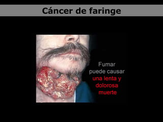 Cáncer de faringe 