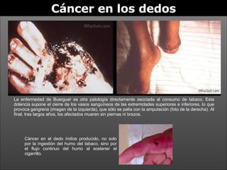 Cáncer en los dedos La enfermedad de Buerguer es otra patología directamente asociada al consumo de tabaco. Esta dolencia supone el cierre de los vasos sanguíneos de las extremidades superiores e inferiores, lo que provoca gangrena (imagen de la izquierda), que sólo se palia con la amputación (foto de la derecha). Al final, tras largos años, los afectados mueren sin piernas ni brazos. Cáncer en el dedo índice producido, no solo por la ingestión del humo del tabaco, sino por el flujo continuo del humo al sostener el cigarrillo. 
