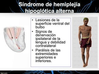 • Lesiones de la
superficie ventral del
bulbo
• Signos de
denervación
ipsilateral de la
lengua y debilidad
contralateral
• Parálisis de las
extremidades
superiores e
inferiores.
 
