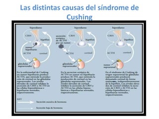 Las distintas causas del síndrome de
Cushing
 