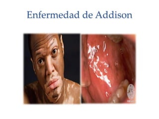 Enfermedad de Addison
 