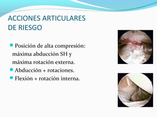 ACCIONES ARTICULARES
DE RIESGO

Posición de alta compresión:
 máxima abducción SH y
 máxima rotación externa.
Abducción + rotaciones.
Flexión + rotación interna.
 