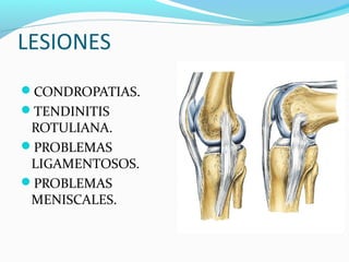 LESIONES
CONDROPATIAS.
TENDINITIS
 ROTULIANA.
PROBLEMAS
 LIGAMENTOSOS.
PROBLEMAS
 MENISCALES.
 