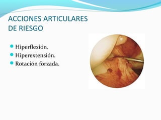 ACCIONES ARTICULARES
DE RIESGO

Hiperflexión.
Hiperextensión.
Rotación forzada.
 