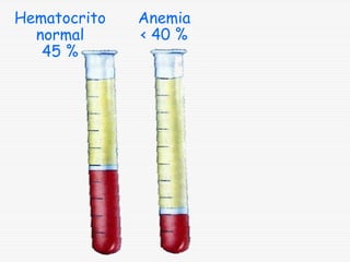 Hematocrito
normal
45 %

Anemia
< 40 %

 