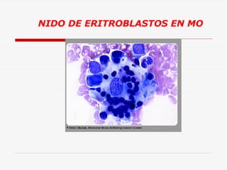 NIDO DE ERITROBLASTOS EN MO

 