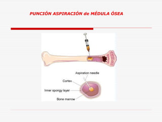 PUNCIÓN ASPIRACIÓN de MÉDULA ÓSEA

 