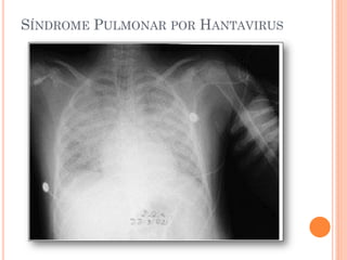 SÍNDROME PULMONAR POR HANTAVIRUS
 