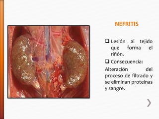 NEFRITIS 
 Lesión al tejido 
que forma el 
riñón. 
 Consecuencia: 
Alteración del 
proceso de filtrado y 
se eliminan proteínas 
y sangre. 
 